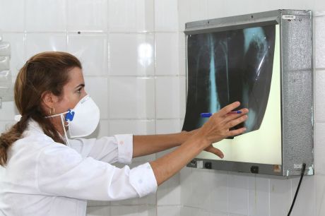 Brasil registra 78 mil novos casos de tuberculose