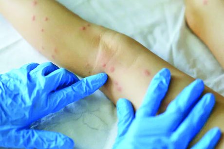 OMS alerta para variante mais perigosa de mpox